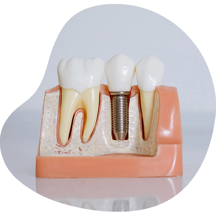 Dental implantology treatment procedure in Antalya