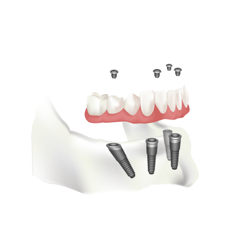 What is an immediate implant?