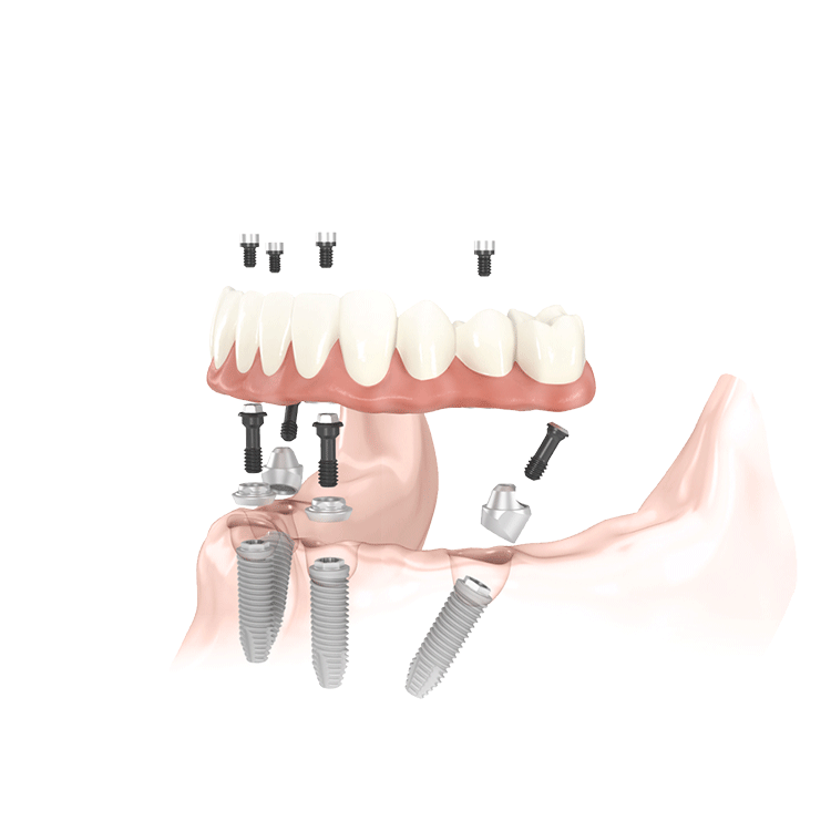 All-on-4 implant in Antalya